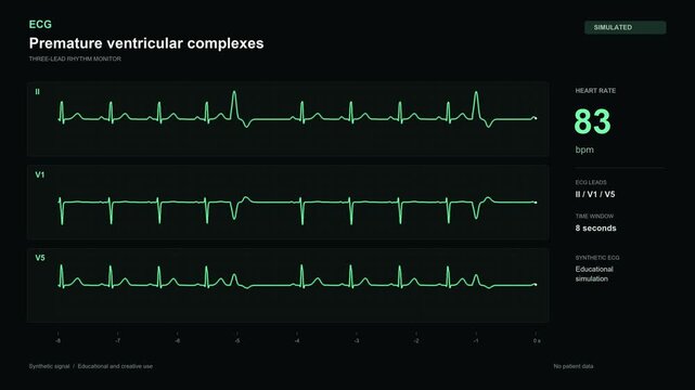 Premature ventricular complexes ECG monitor simulation on black