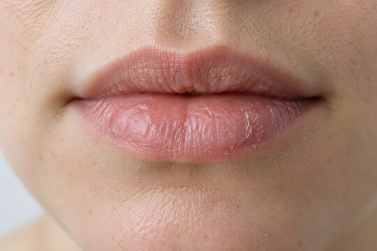 Close up of dry chapped lips with flaky skin