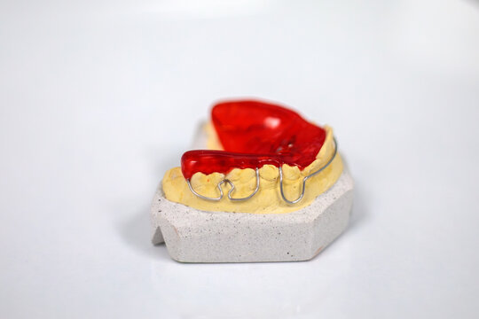 Bright red glossy acrylic orthodontic plate on yellow plaster dental model with white stone base, dentistry concept of healthy teeth and correct bite, grainy film texture, high quality photo