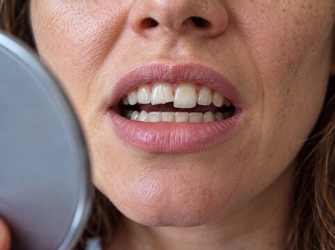 Person checking chipped front tooth in mirror