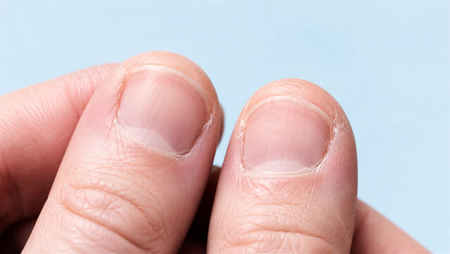 close-up of two fingernails showing vertical ridges and dry cuticles against a blue background. Nail health and grooming. Dermatology and personal care. Macro detail with copy space