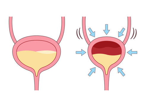 Medical Illustration Comparing Normal Bladder and Overactive Bladder with Urinary Urgency Pressure Arrows
