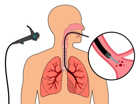 Medical Illustration of a Bronchoscopy Procedure with Lung Biopsy Detail and Respiratory System Anatomy