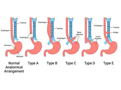 Esophageal Atresia and Tracheoesophageal Fistula Classification Diagram, Normal Anatomy vs Types A, B, C, D, E Comparative Medical Illustration