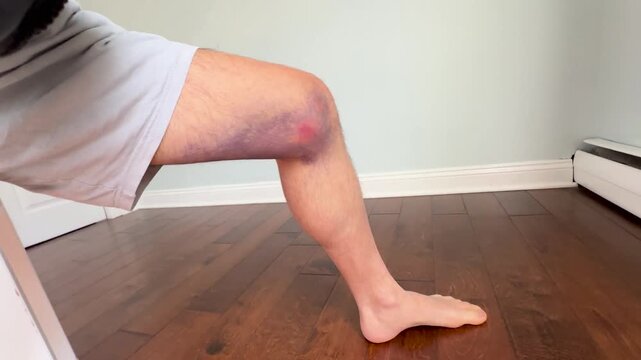 Large purple bruise on male knee from sports injury, side view of bare leg standing on hardwood floor