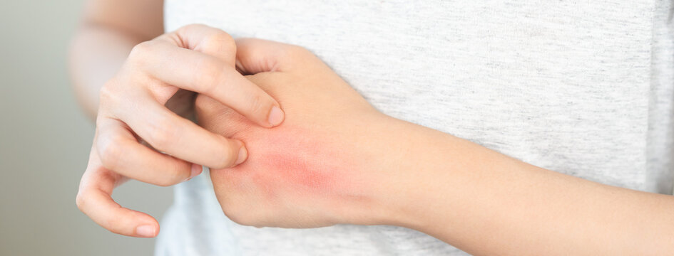 Dermatology asian young woman allergy, allergic reaction from atopic, insect bite, scratching itchy back of hand, red spot or rash of skin. Healthcare treatment of beauty. Isolated on white background