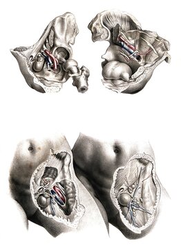 Medicine, human anatomy, femoral hernia, femoral hernia, also called femoral hernia, refers to hernia gaps directly below the so-called inguinal ligament. The femoral hernia occurs where the large blood vessels of the leg enter the abdominal cavity. Coloured lithograph by J. Maclise, 1841, 1844, Historical, digitally restored reproduction from a 19th century original