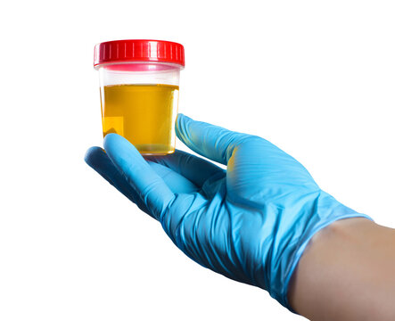 Hand in blue glove presenting urine specimen cup for laboratory analysis, isolated on transparent cutout background