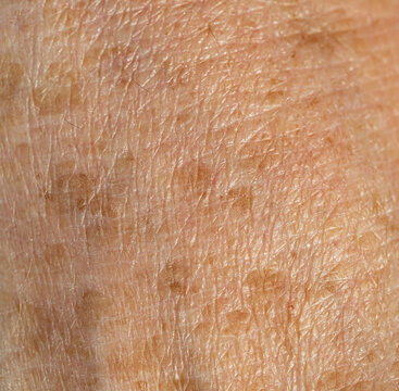 Close-up of aged skin with visible wrinkles and brown spots