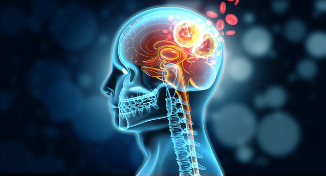Detailed human head and brain anatomy showing malignant brain tumor growth, glowing cancer cells, medical diagnostic, neurological disease concept.