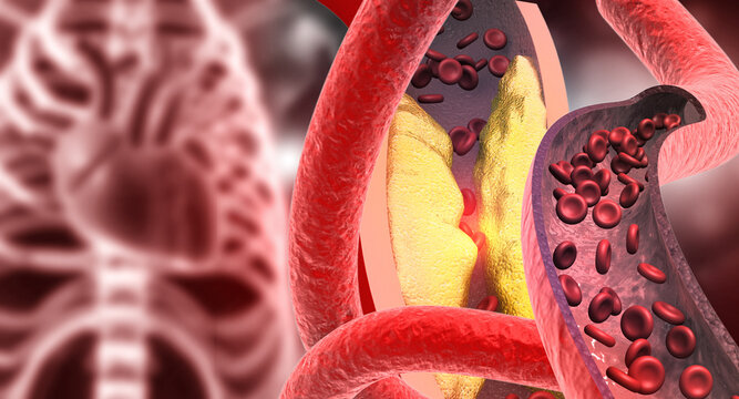Detailed medical illustration of cholesterol blocked human artery showing plaque buildup, restricted blood flow, cardiovascular disease concept.