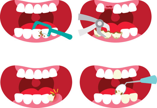 Four Dental Treatment Procedures for Tooth Restoration and Oral Care
