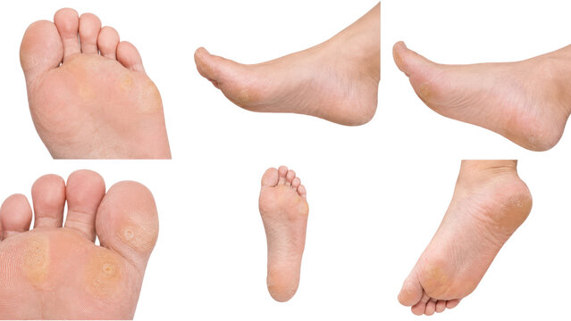 Multiple close-up views of a bare adult foot and soles showing calluses and toes on a transparent background