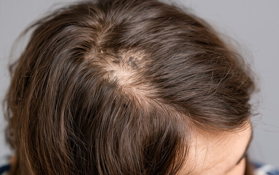 the scalp shows a bald patch from alopecia areata in closeup