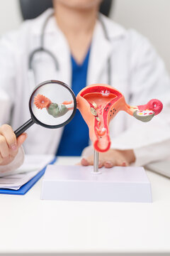 Doctor with Uterus and Ovaries anatomy model. Ovarian and Cervical cancer, Cervix disorder, Endometriosis, Hysterectomy, Uterine fibroids, Reproductive system, Pregnancy and health concept