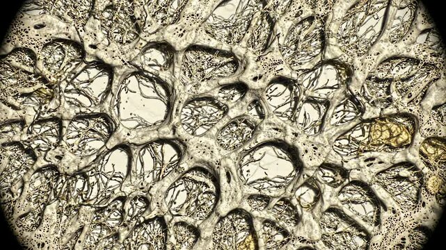 Healthy cancellous bone toward chronic osteoporosis, beginning with dense, well-connected trabecular bone structures and realistic bone marrow spaces, then gradually showing thinning trabeculae