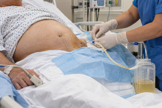 Paracentesis Procedure for Ascites and Abdominal Fluid Drainage