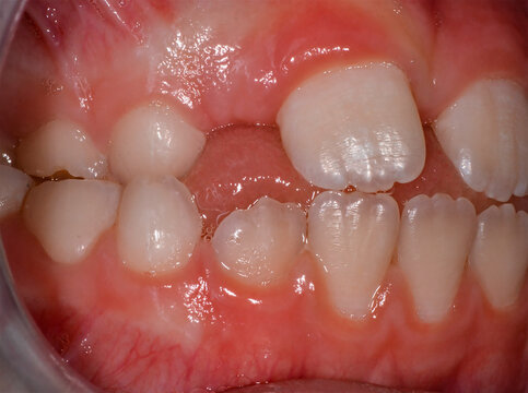 Close up dental macro photography showing human teeth bite gums enamel texture and malocclusion inside open mouth