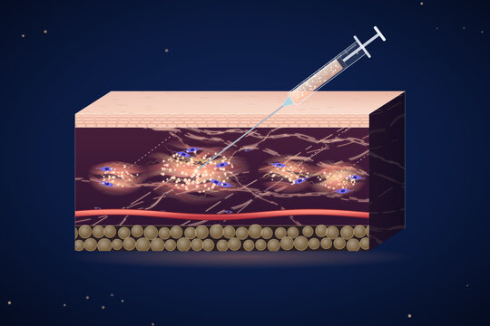 Skin booster injection into the dermis, syringe delivering particles that support the collagen and elastin extracellular matrix, skin cross section