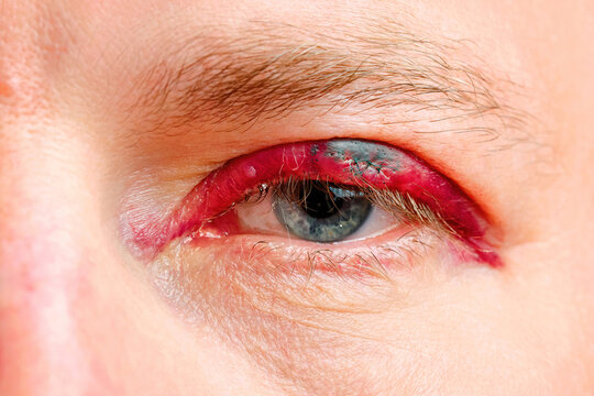 Human eye with severely inflamed red upper eyelid after chalazion removal surgery, bruising and stitches. Red swollen eyelid with surgical incision and dark crusting after chalazion removal procedure