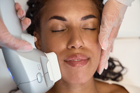 SMAS lifting with high intensity focused ultrasound for facial rejuvenation and collagen stimulation. African woman receives a noninvasive cheek tightening treatment.