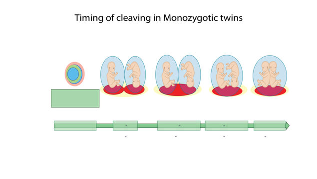  Timing of cleaving in Monozygotic twins, Medical illustration showing the timing of embryonic cleavage in monozygotic (identical) twins and its relationship to chorionicity and amnionicity. 