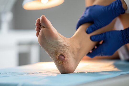 Podiatry examination of a heel wound with dry surrounding skin