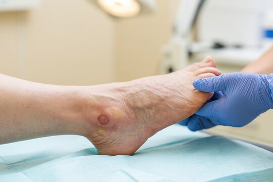 Gloved hand supporting a foot with a circular skin wound near the ankle