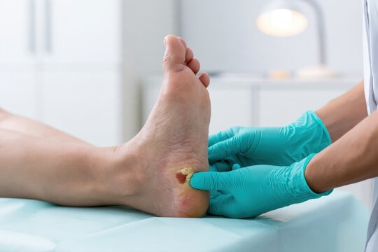 Podiatrist assessing a heel wound with thickened surrounding skin