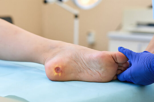 Close-up of a heel wound during a gloved foot examination