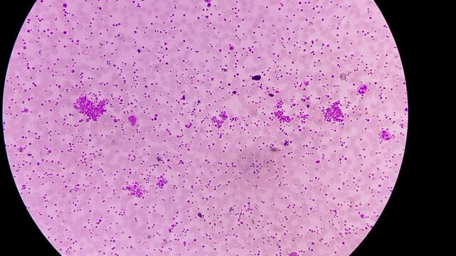 Thrombocytosis. Platelet increased in number. Microscopic footage of complete blood count (CBC). 