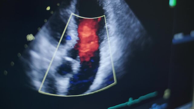Video of Echocardiogram Ultrasound Examination
