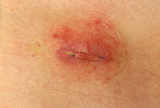 Close-up of a doctor examining a postoperative surgical wound with granulation tissue, sutures and redness during tissue repair. Useful for medical education, wound care, surgery and recovery content.
