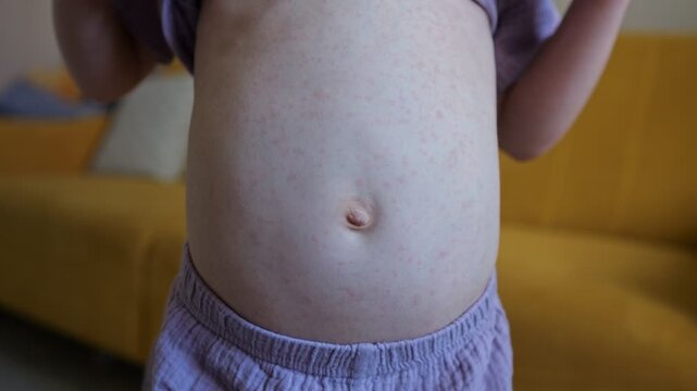 Small Child Shows Rash Covered Belly While Lifting Lavender Shirt Indoors. Youngster Stands Near Modern Couch Revealing Viral Dermatitis Spots Across Abdomen, Requiring Parental Healthcare.