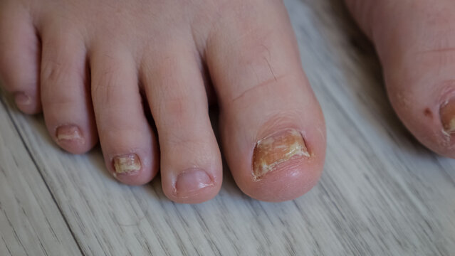Fungal Nail Infection Affects Toes, Revealing Crumbling Yellowed Texture. Bare Foot Exhibits Dystrophic Toenails With Visible Onychomycosis Damage, Placed On Pale Wooden Floor Surface Indoors.