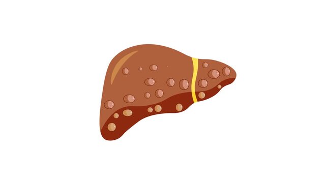 Medical vector animation displaying human liver anatomy covered in diffuse regenerative nodules and fibrotic parenchymal scarring, highlighting liver cirrhosis, hepatocellular carcinoma, nonalcoholic 