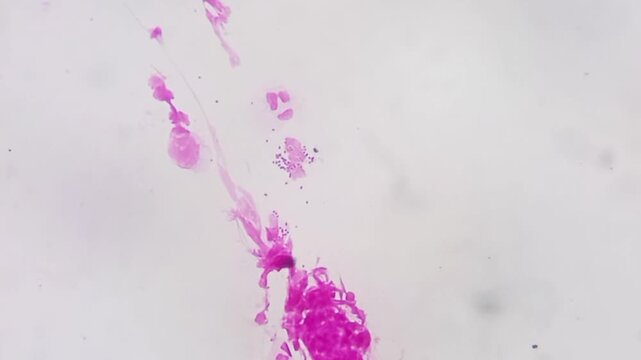 Microscopic footage of urethral smear for Gram stain. Gram negative intra and extracellular diplococci are seen. Neisseria gonorrhoeae bacteria in urethral smear. 