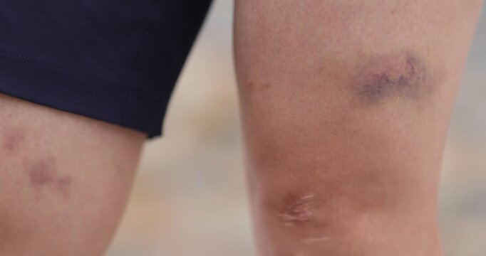 People show the bruised legs