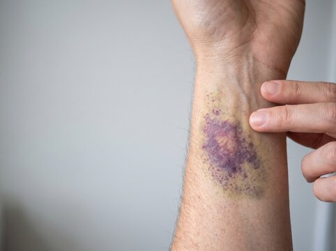 Close-up of a persons arm showing a large bruise on the wrist.