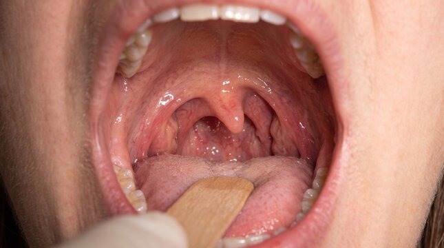 Deviated Uvula: Clinical Sign of Palatal Weakness