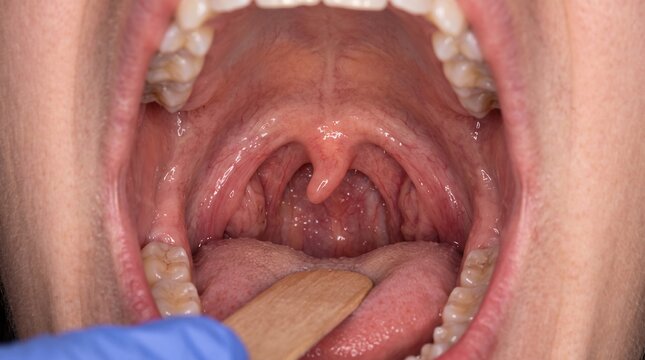 Clinical Photograph Demonstrating Uvular Deviation