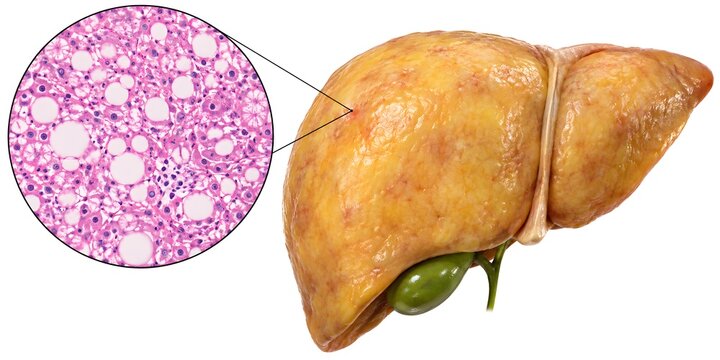 Fatty Liver Disease Hepatic Steatosis with Microscopic Biopsy Histology Callout Showing Lipid Droplets Isolated on White Background