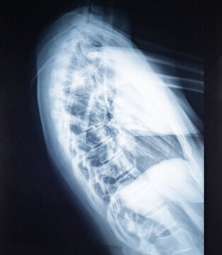 X-ray showing human spine with kyphosis, sagittal view of vertebrae for medical diagnosis and health assessment