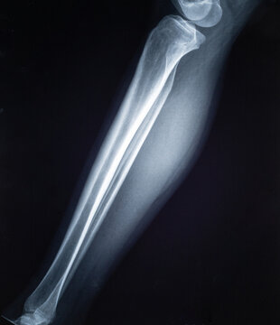 Human leg X-ray showing tibia, fibula, knee, and ankle bones on a dark background for medical diagnosis