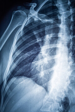 Chest x-ray imaging showing human anatomy, ribs, spine, shoulder, clavicle, and lungs for medical diagnosis