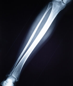 Human leg X-ray showing tibia, fibula, and ankle bones helping diagnose and understand bone structure