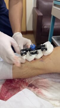 Bandages are wrapped around a tibial transverse transport external fixator on a patient's lower leg after surgery for diabetic foot treatment.