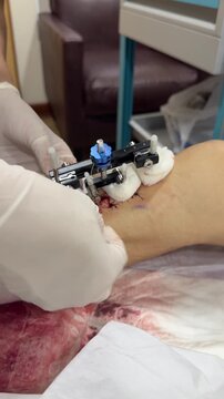 Medical professional applies bandages around a tibial transverse transport fixator after placement on the lower leg. Surgical dressing during treatment for diabetic foot.