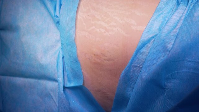 Professional surgeon in sterile gloves making an incision with a scalpel on a patient's abdomen with stretch marks, performing a tummy tuck procedure in a modern aesthetic surgery clinic