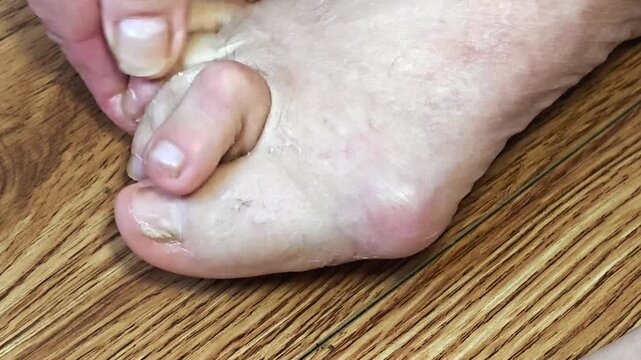 Close-up of elderly feet with hammertoe and bunion deformity on wooden floor, foot problems and toe correction concept